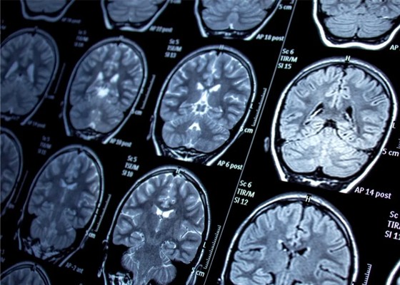 Brain Tumour Segmentation